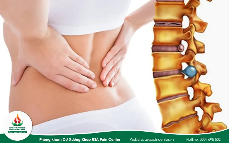 triệu chứng điển hình của thoát vị đĩa đệm