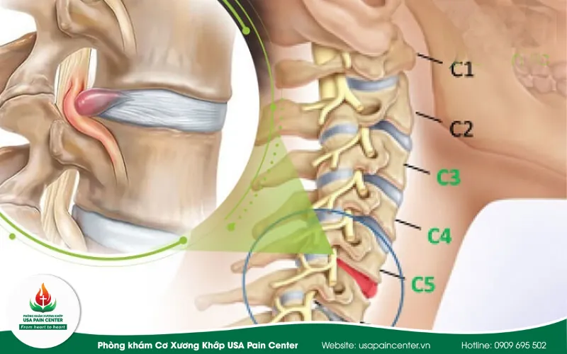 Thoát vị đĩa đệm đốt sống cổ
