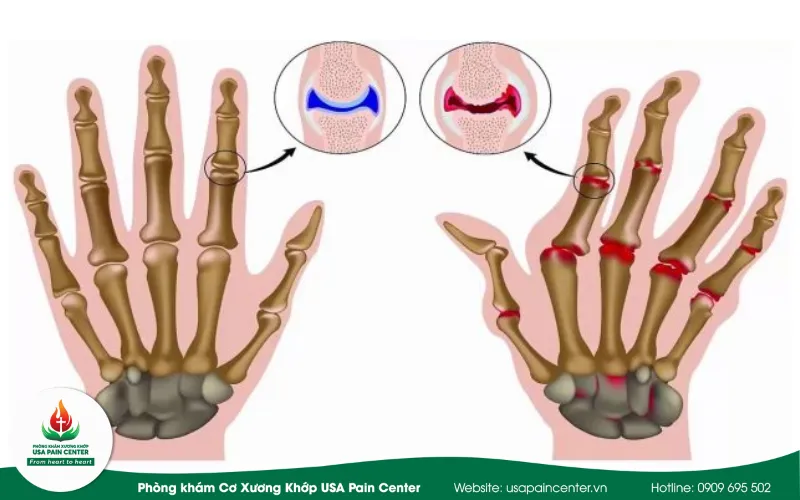 triệu chứng của bệnh viêm khớp thấp