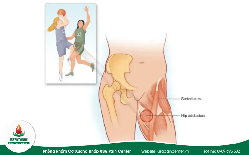 Chấn thương ở vùng háng
