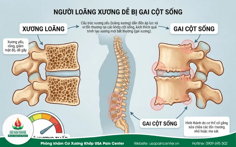 Người bị loãng xương dễ bị gai cột sống