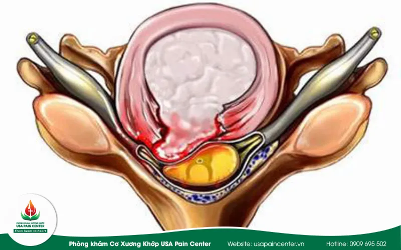 TÌnh trạng phồng đĩa đệm 