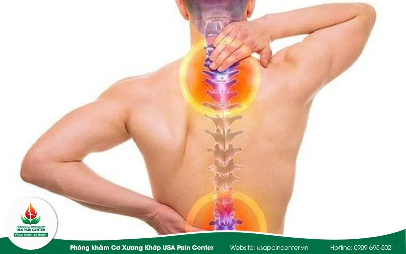 Các cách phòng ngừa gai cột sống ở người bị loãng xương