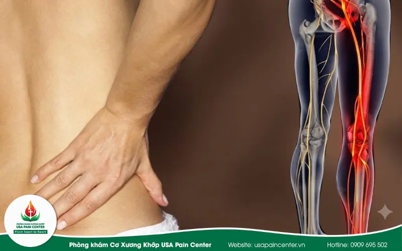 rách nhân nhầy đĩa đệm gây đau