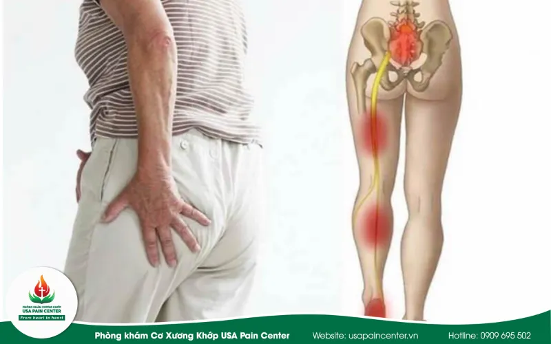 biến chứng thoát vị đĩa đệm
