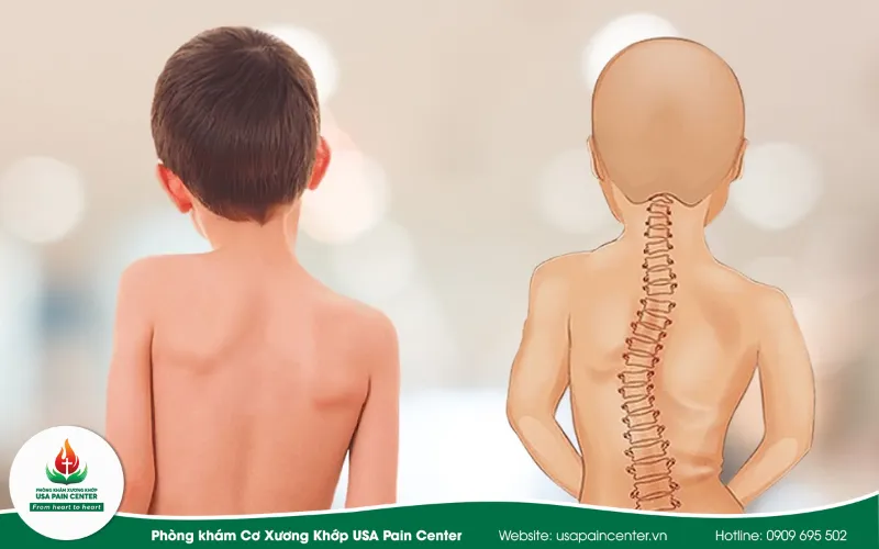 Vẹo Cột Sống và Góc Cobb