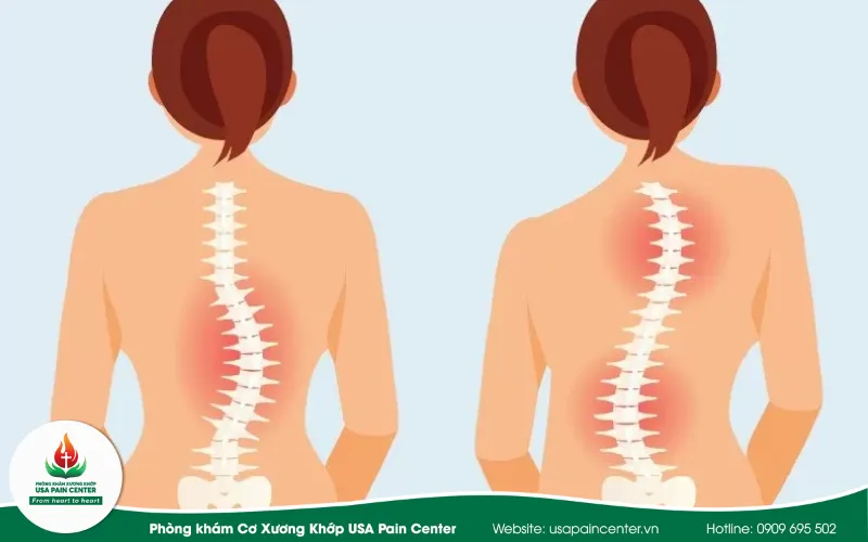 vẹo cột sống vô căn