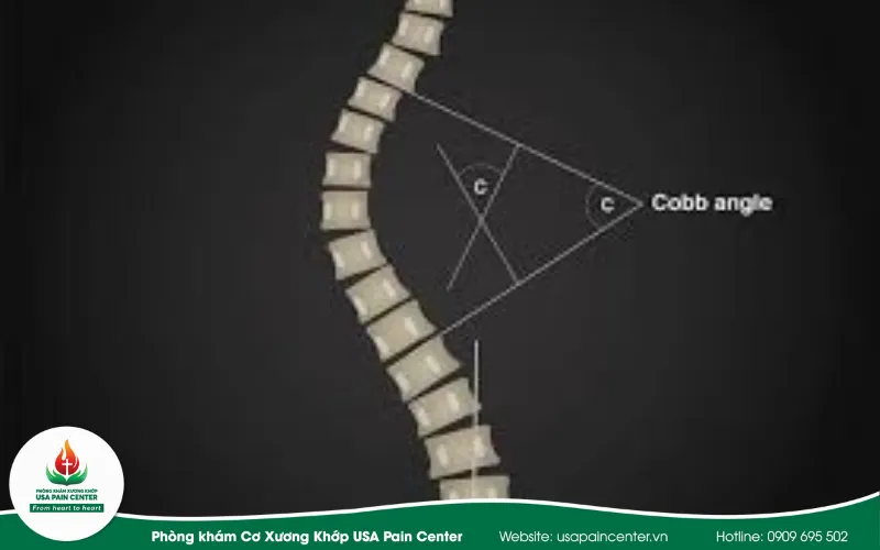 góc cobb dưới 20 độ
