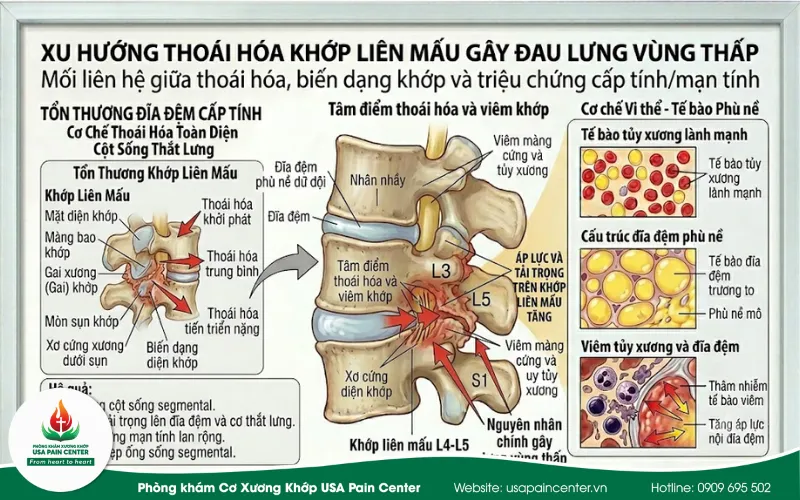 Xu hướng thoái hóa khớp liên mấu gây đau lưng vùng thấp