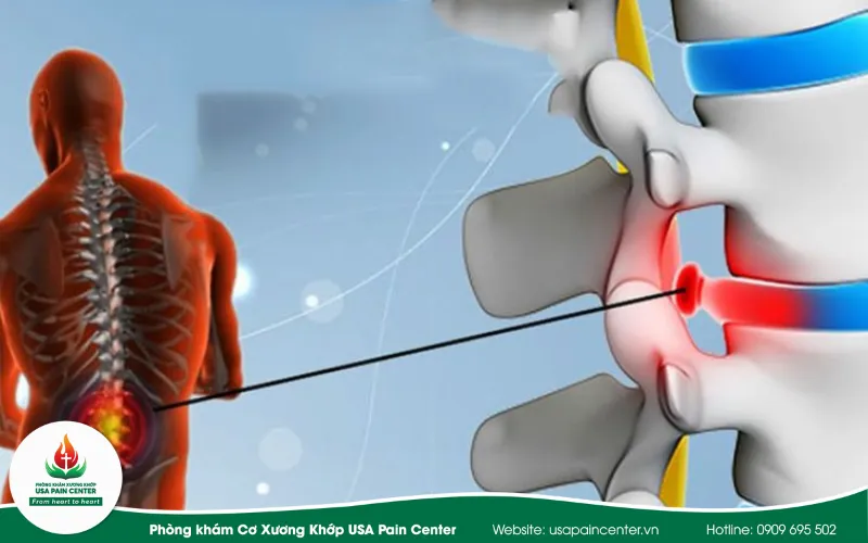 phù nề sưng đĩa đệm cột sống