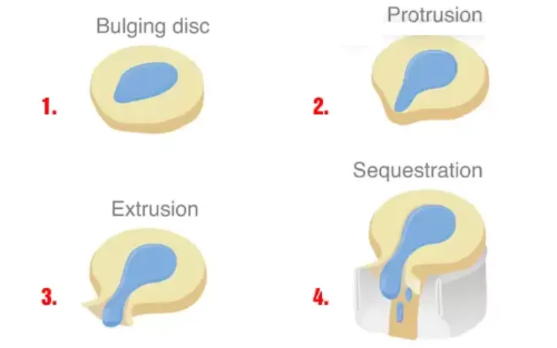 các dạng thoát vị đĩa đệm thường gặp thuật ngữ trên phim MRI cột sống