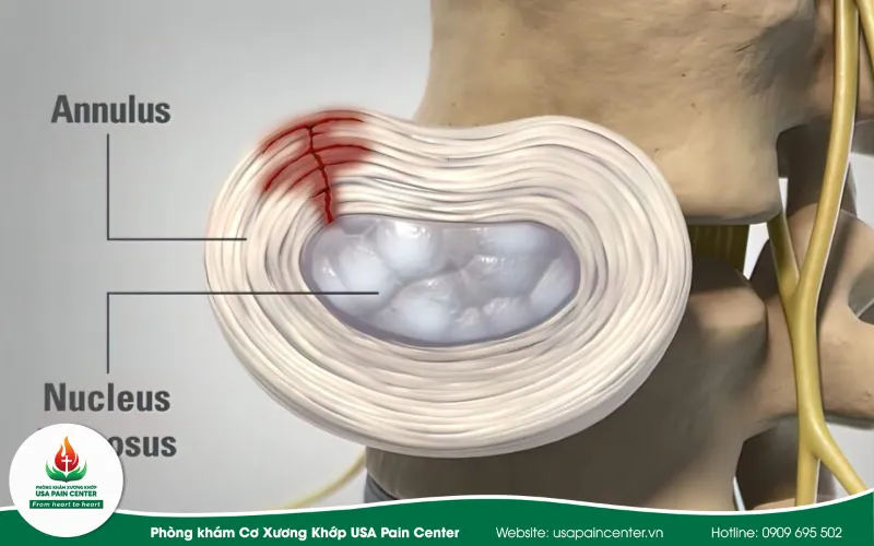 nứt vòng sợi thuật ngữ trên phim MRI cột sống