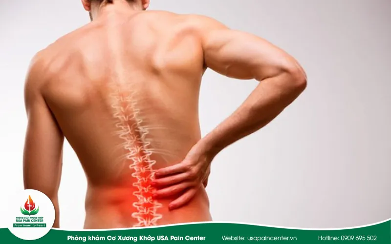 Tình trạng tụ máu và sưng phù nề quanh đốt sống