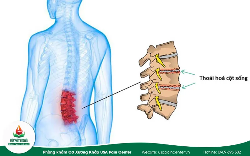 Quá trình thoái hóa cột sống 