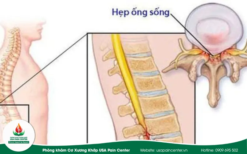 trình trạng hẹp đốt sống do dây chằng vàng