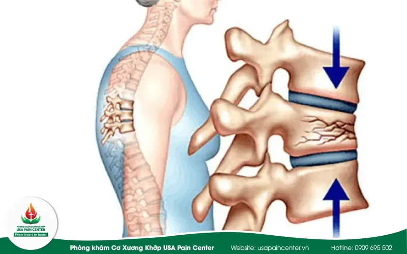 tổn thương phần mềm quanh thân đốt sống