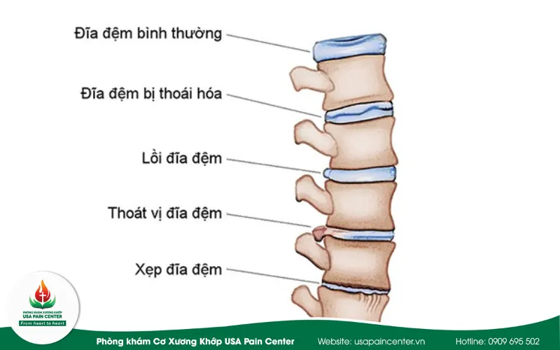 Xẹp đĩa đệm cũng là nguyên nhân dẫn tới thoát vị