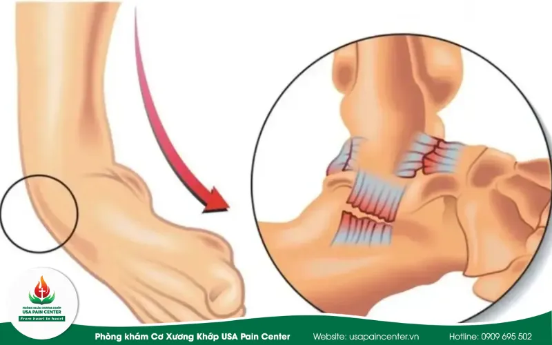 chấn thương dây chằng phổ biến