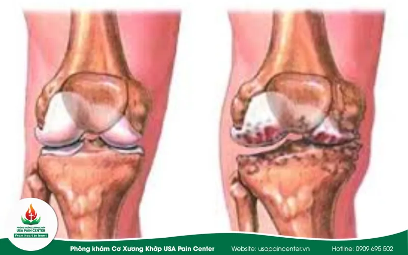 sai lầm khi gia cố khớp gối