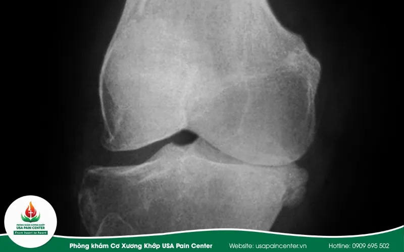 Một số phương pháp điều trị khác