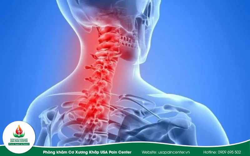 Cách chữa đau mỏi vai gáy tại nhà an toàn theo mức độ