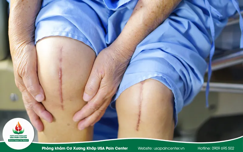 Thoái Hóa Khớp Gối Có Cần Phải Mổ Không? Giải Đáp Chuẩn Y Khoa