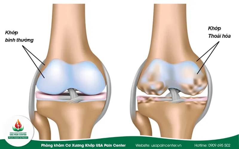 Thoái hóa khớp gối có cần phải mổ không?