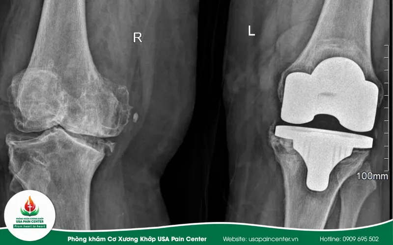 Thoái hóa khớp gối có chữa được không?