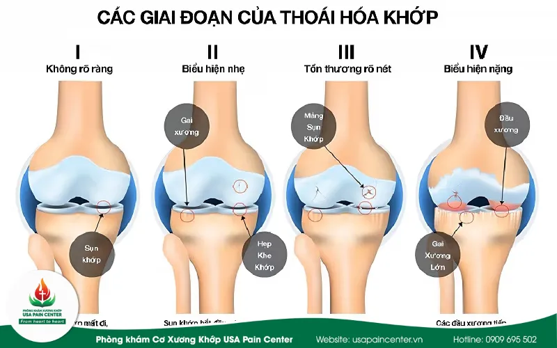Mã M17 Bị Thoái Hóa Khớp Gối Là Gì? 4 Giai Đoạn & Phác Đồ Trị Liệu