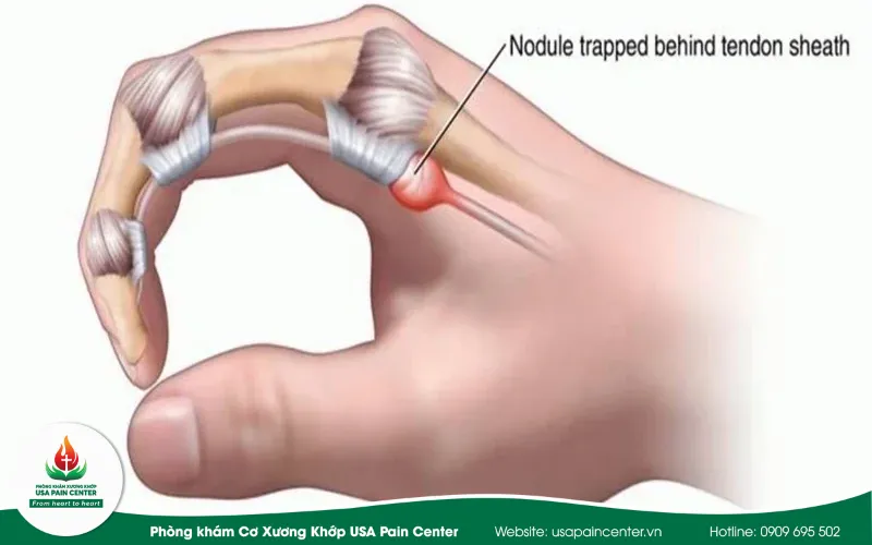 Bệnh ngón tay lò xo là bệnh gì?