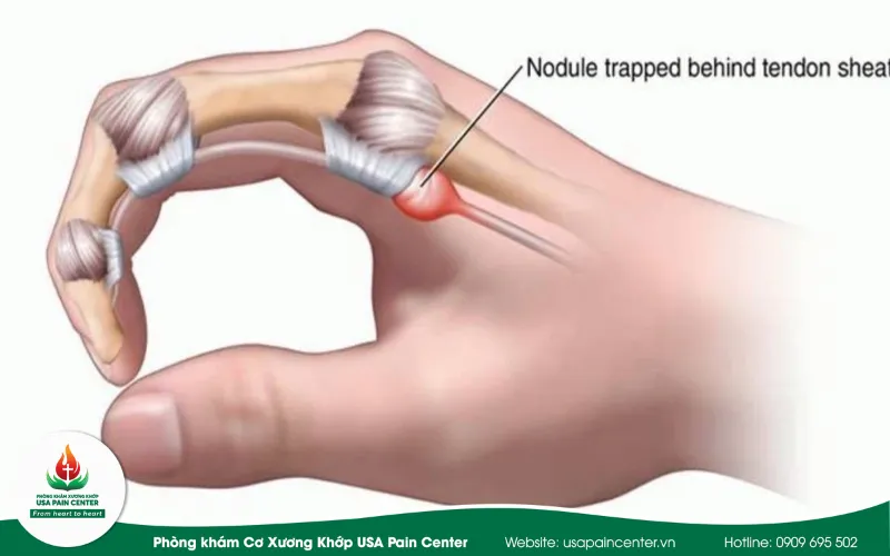 Bệnh Ngón Tay Lò Xo Có Nguy Hiểm Không? Biến Chứng & Phác Đồ Trị Liệu