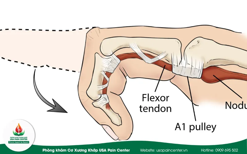 4 cấp độ phát triển của bệnh ngón tay lò xo