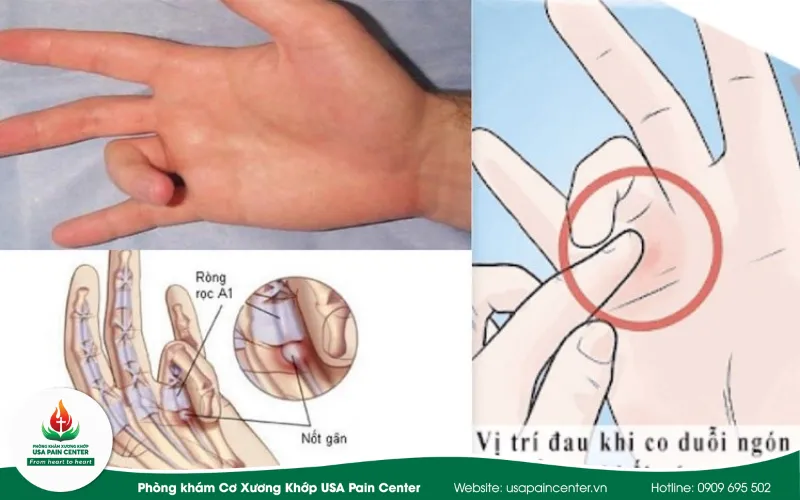 Địa chỉ điều trị bệnh ngón tay lò xò uy tín tại TP.HCM