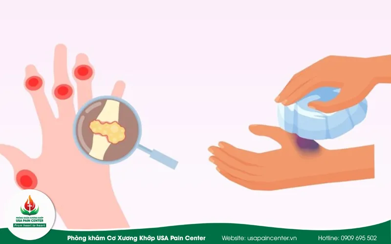 Cách Giảm Đau Nhanh Cho Ngón Tay Lò Xo An Toàn Và Chuẩn Y Khoa