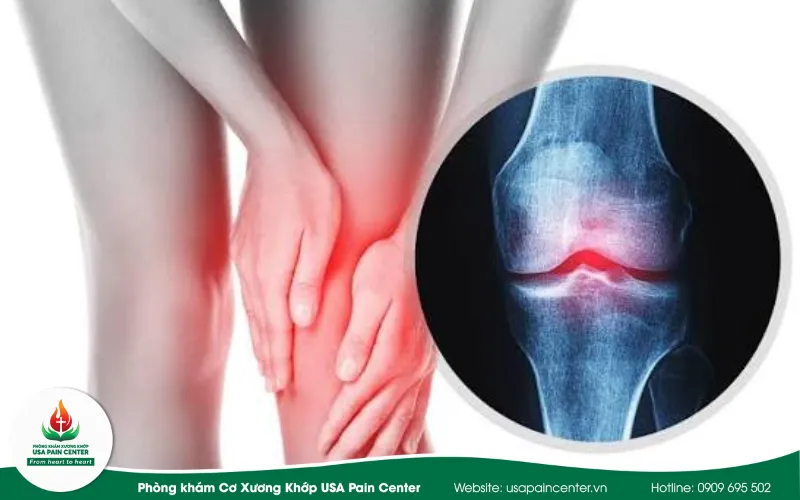 Cách phòng ngừa việc khớp gối kêu lục đục