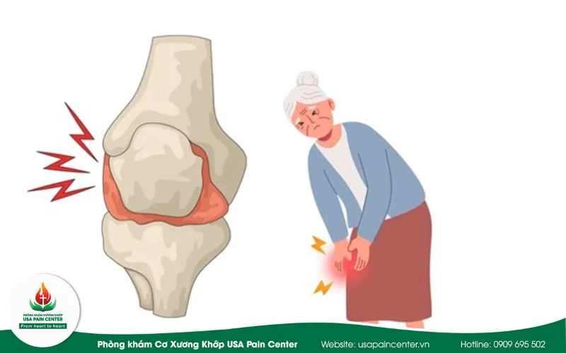 Phác đồ điều trị khớp gối kêu lục cục