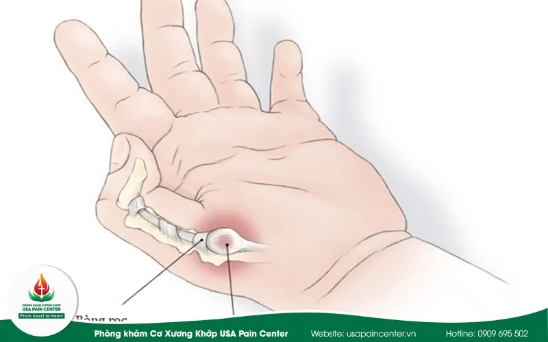 Triệu chứng thường gặp của các bệnh lý đau ngón tay