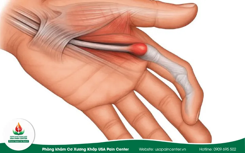 Bị ngón tay lò xo có chữa được không?